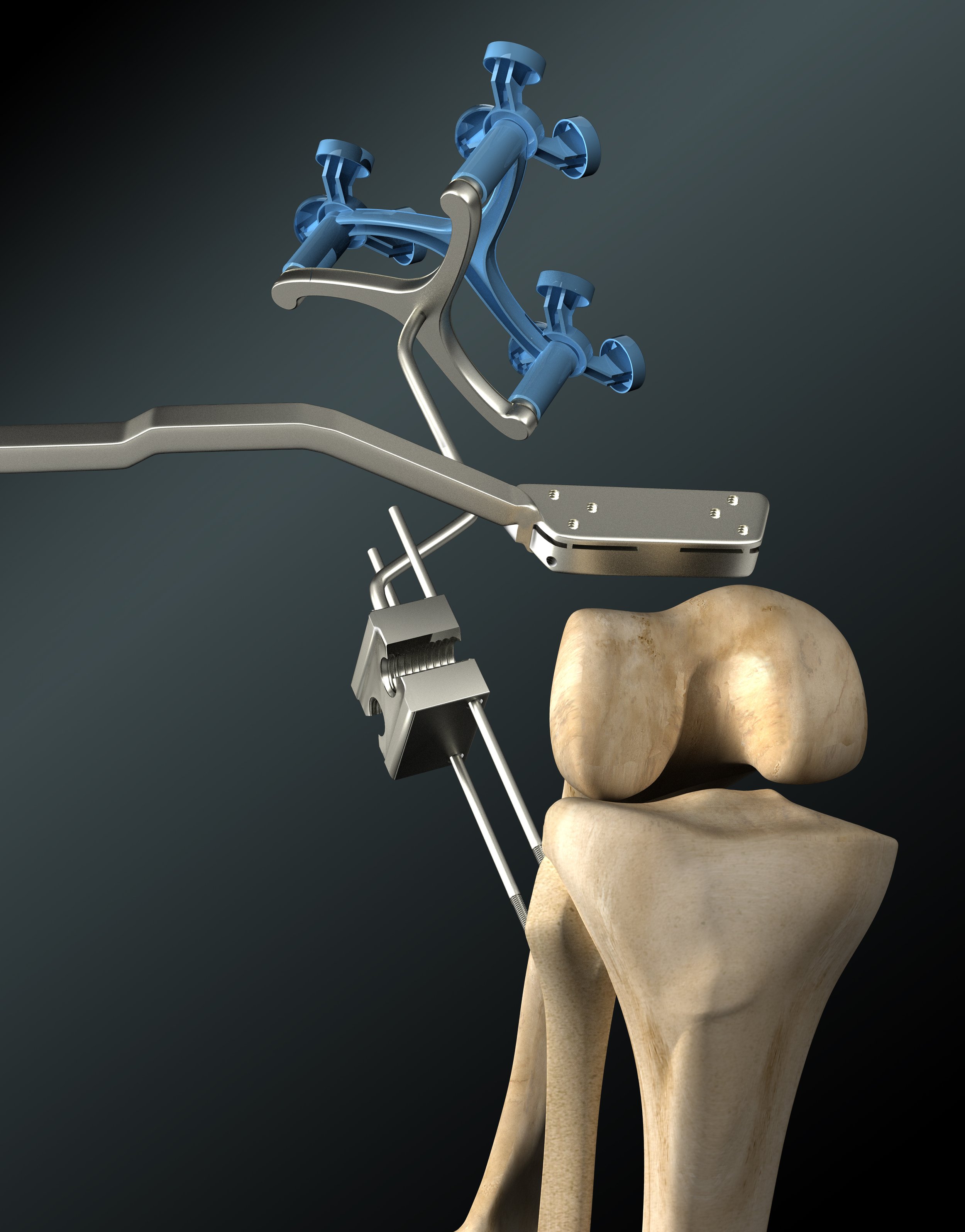 Knee replacement hardware.jpg