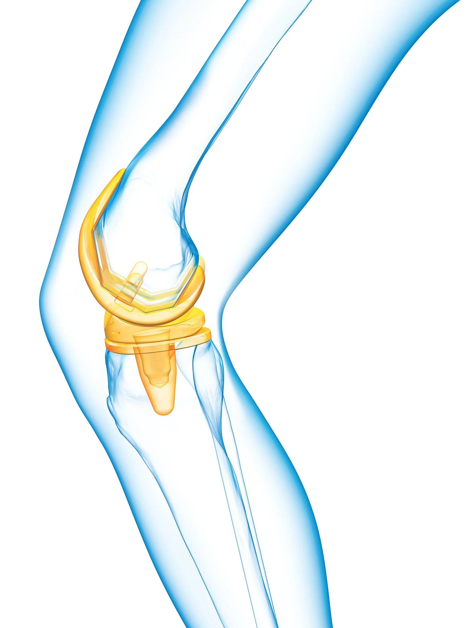 Digital-Knee Replacement2.jpg