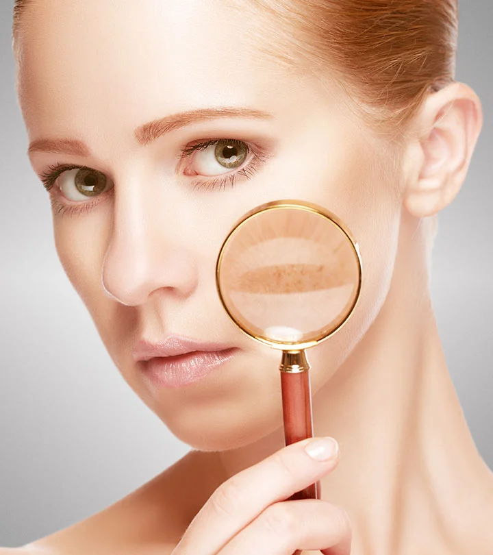 5-17-Tips-To-Remove-Skin-Pigmentation-_234519628.jpg