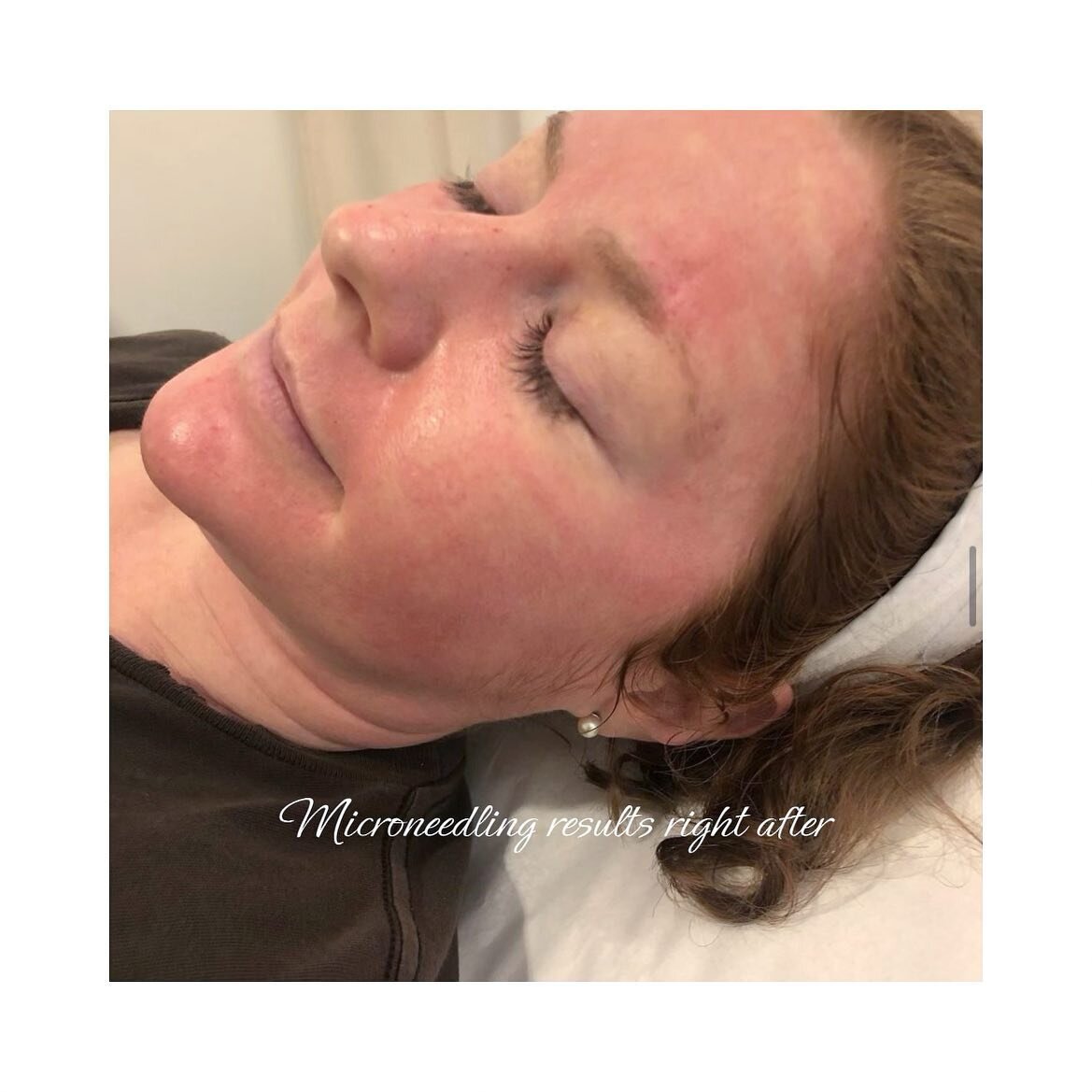 Right after #microneedling. Results set in 2-3 days after treatment. Inquire about our standalone microneedling or with a #PRP combination. #skincare
