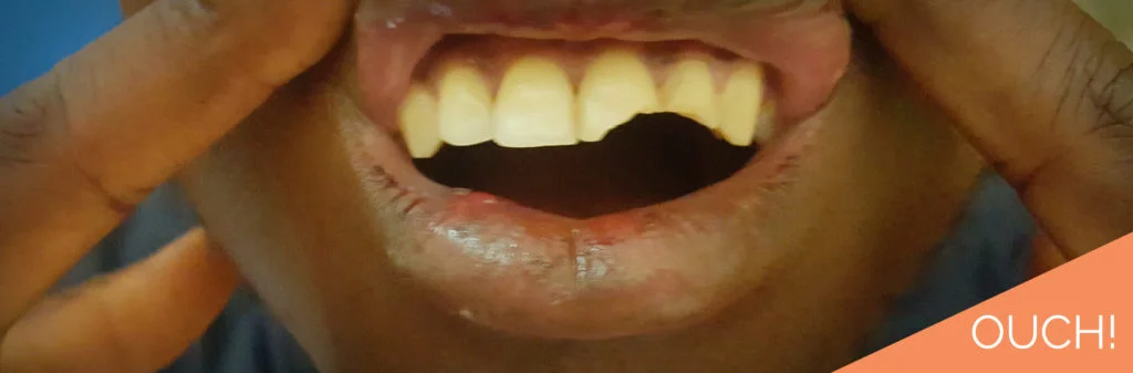 fractured-teeth-1024x337.jpg