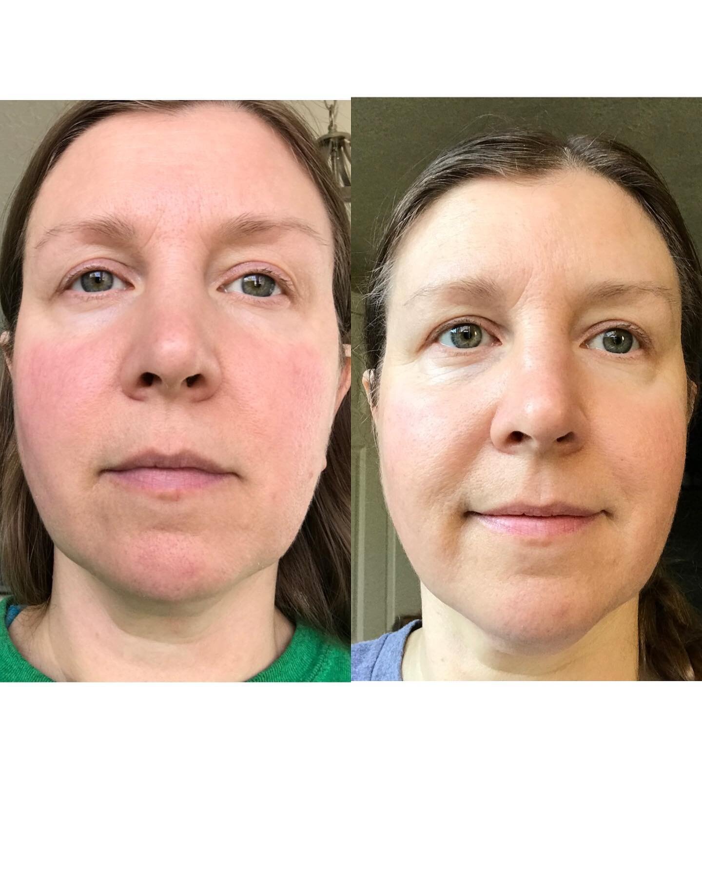 Beauty Formula No.9 before and afters! (Scroll thru). 

🍀 I still can&rsquo;t believe how this formula has exceeded my expectations for rosacea/sensitive skin (and sensitive acne). But it proved what I&rsquo;ve known to be true since I started this 