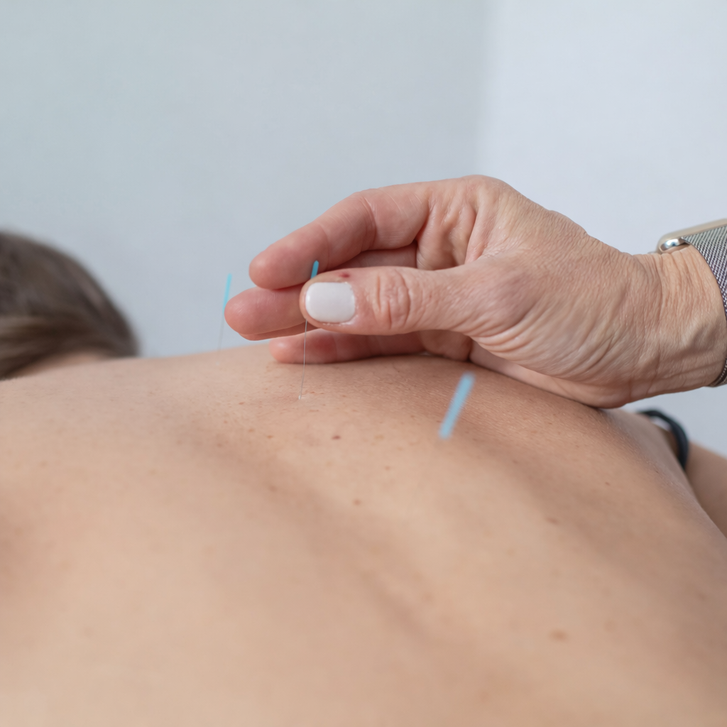 Managing Endometriosis Pain Through Targeted Acupuncture