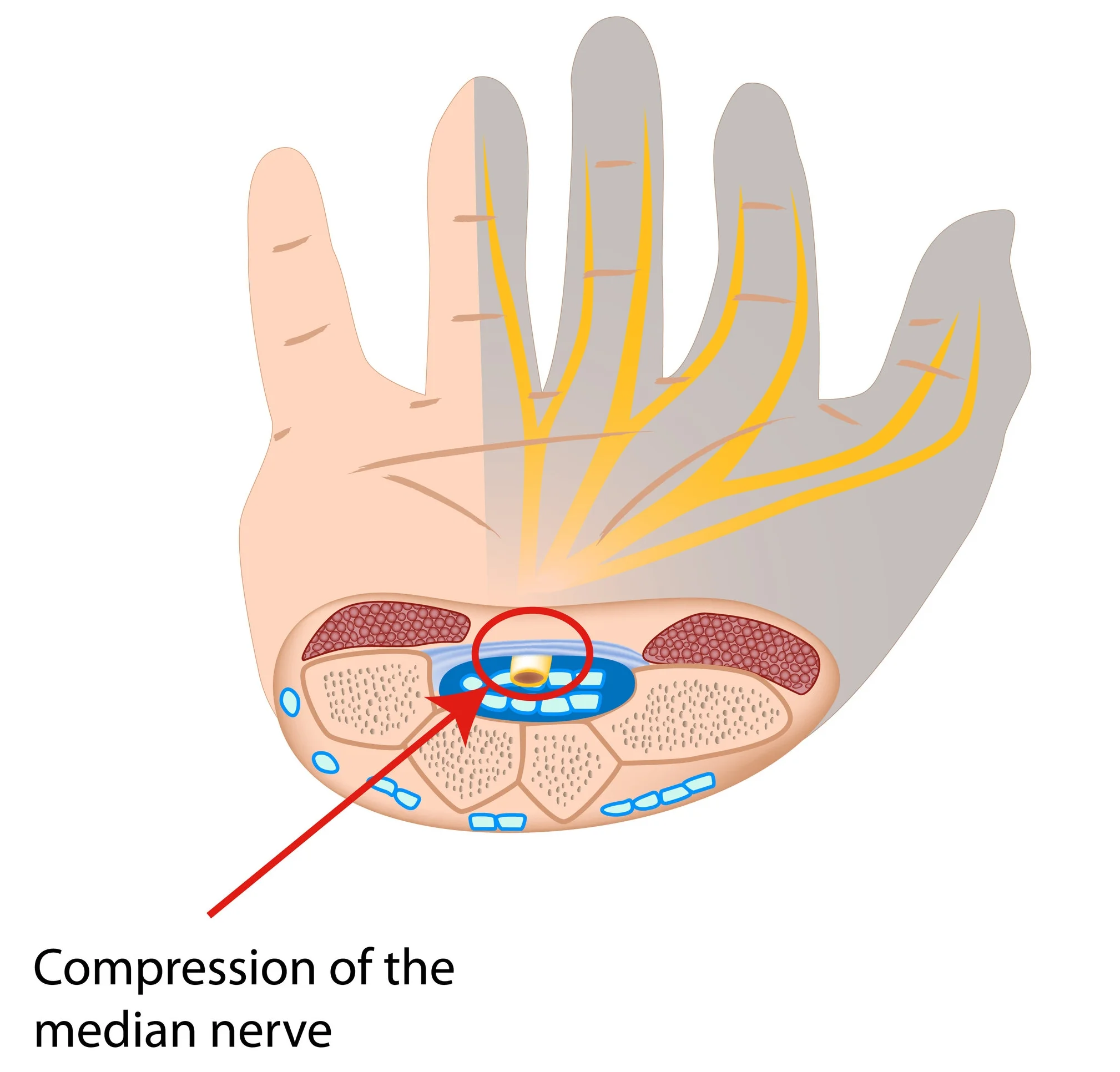 What is Carpal Tunnel Syndrome? Advanced Health & Hand Therapy