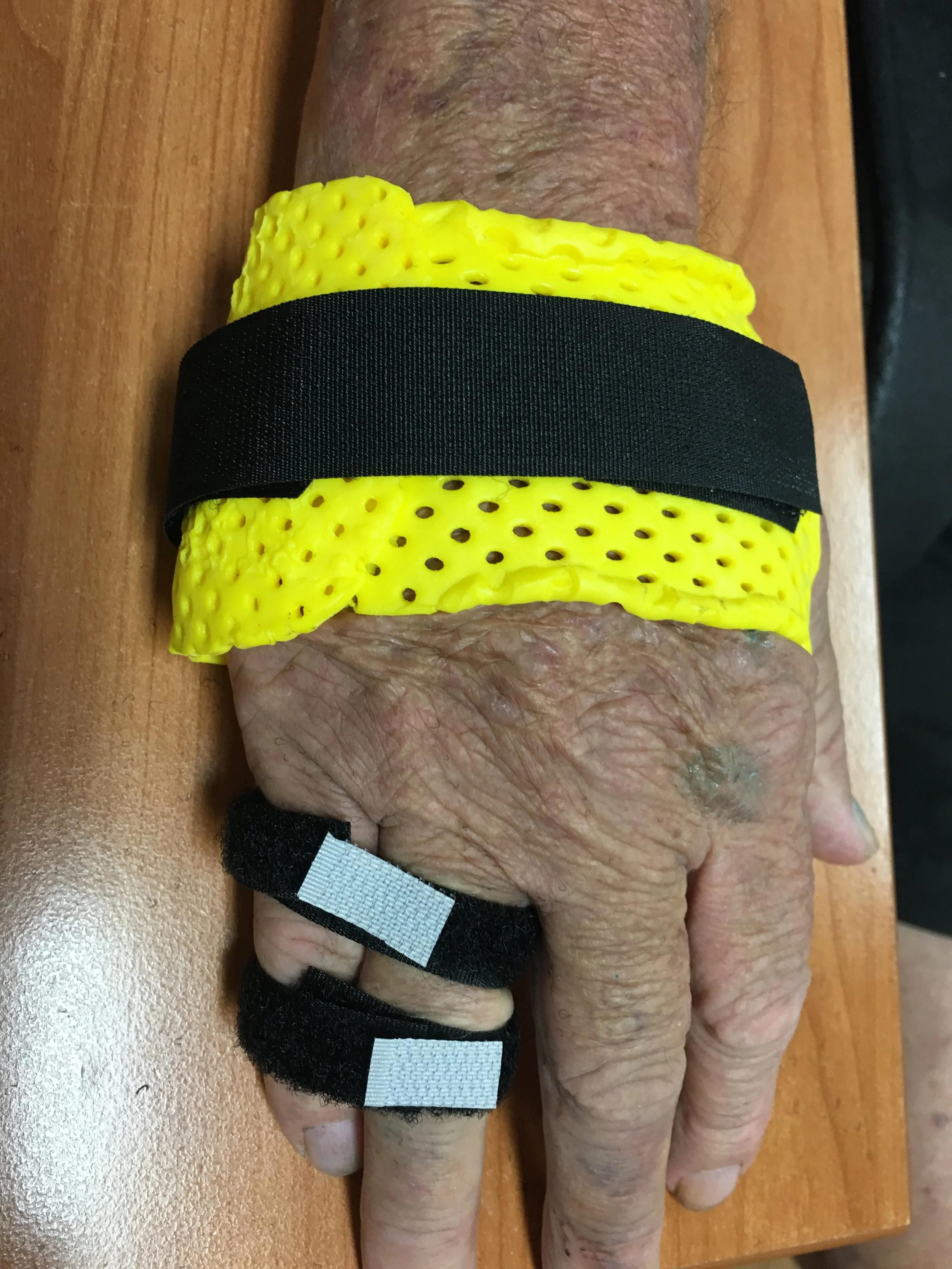 Sarmiento Splint with Buddy Straps