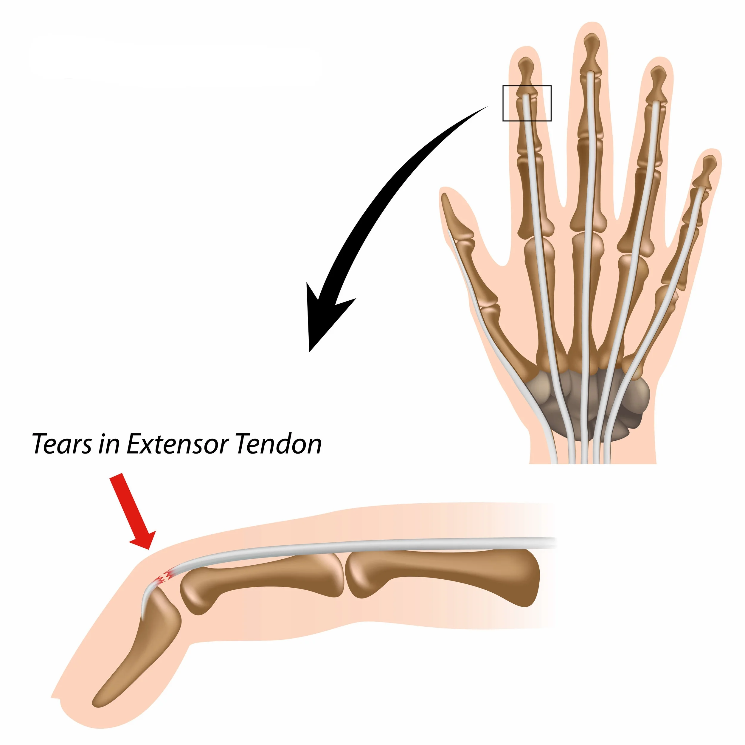 Baseball Finger 9045701 2.jpg