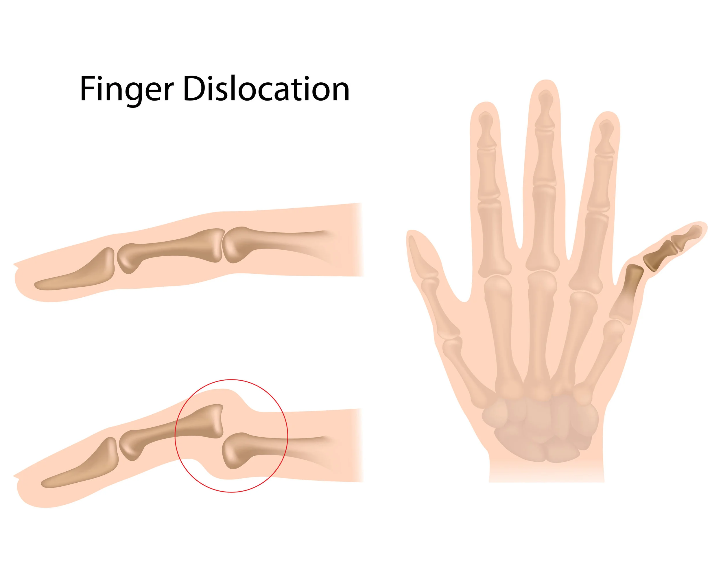 finger dislocation.jpg