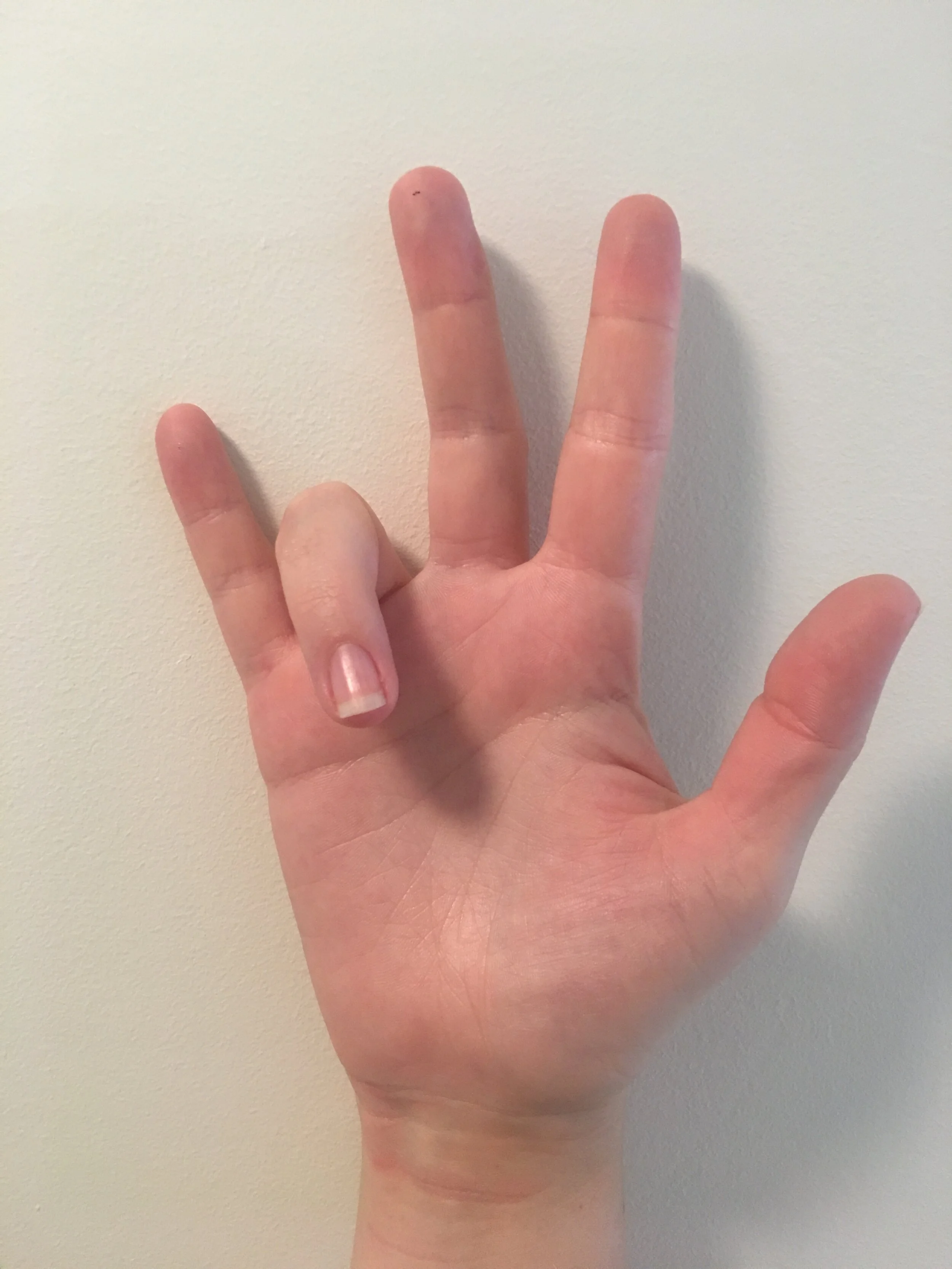 Finger Locking Advanced Health & Hand Therapy