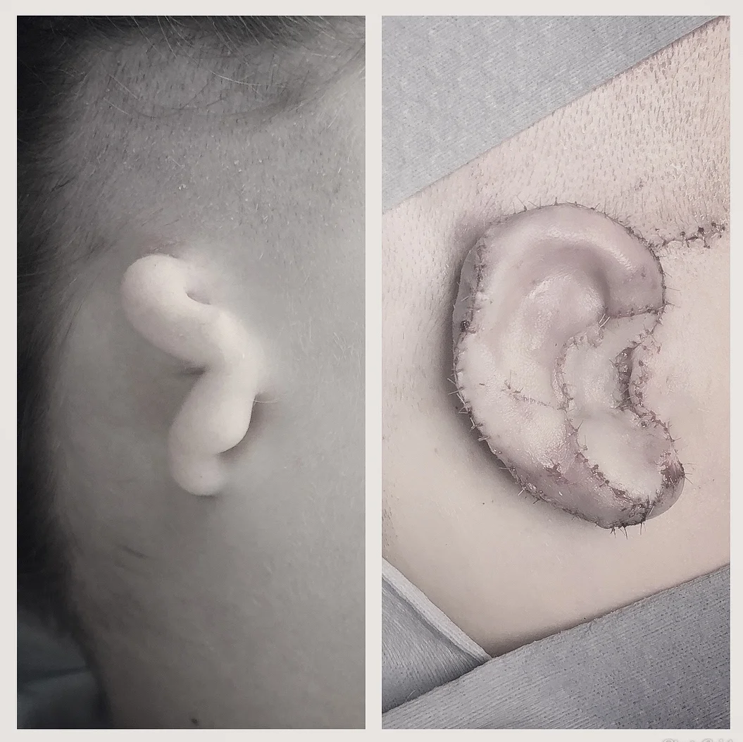 Jo’s brand new ear where there was a tiny earlobe.