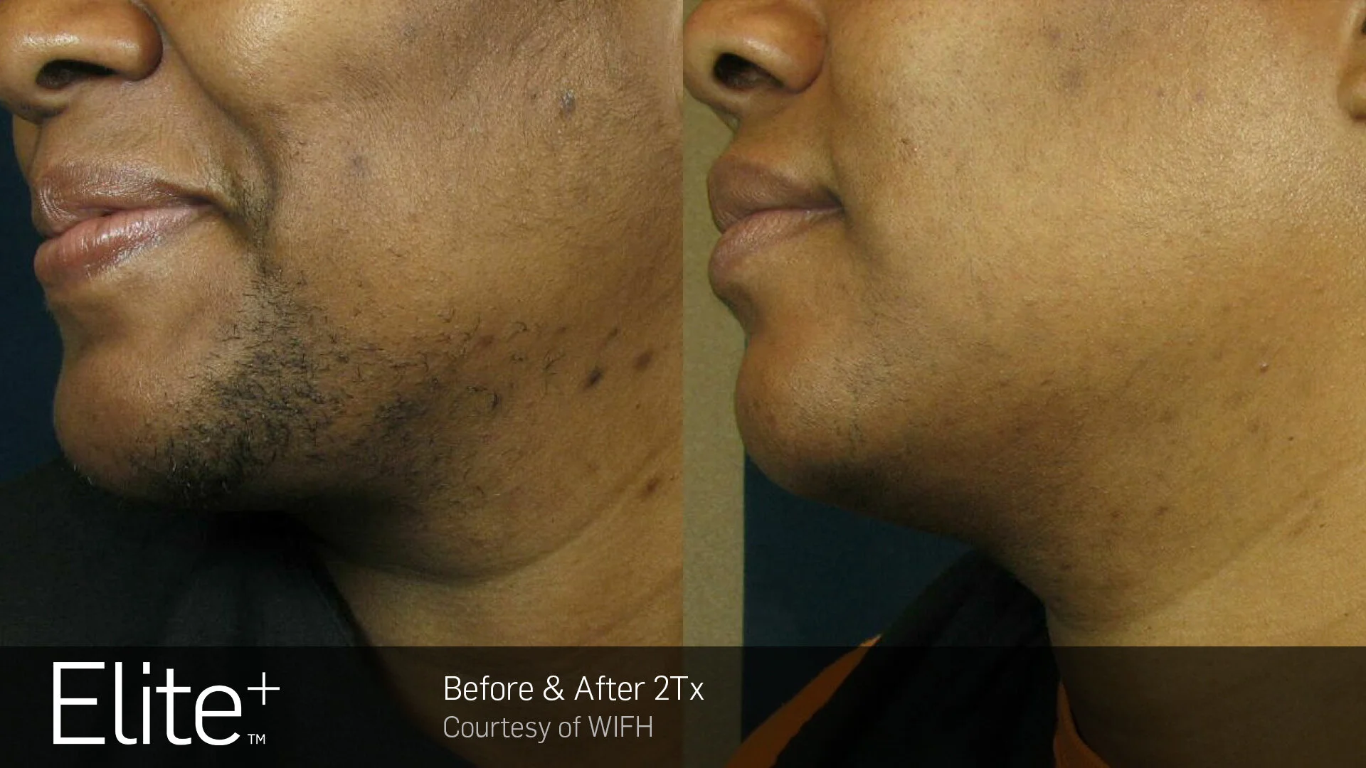 Elite+-Before-&-After-Photo_WIFH(2)- (1).jpg