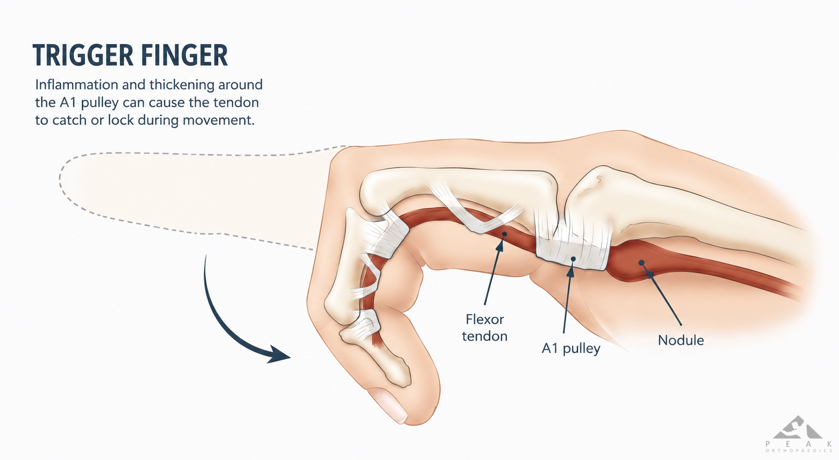 Anatomical illustration demonstrating how a flexor tendon nodule can catch at the A1 pulley and cause trigger finger.