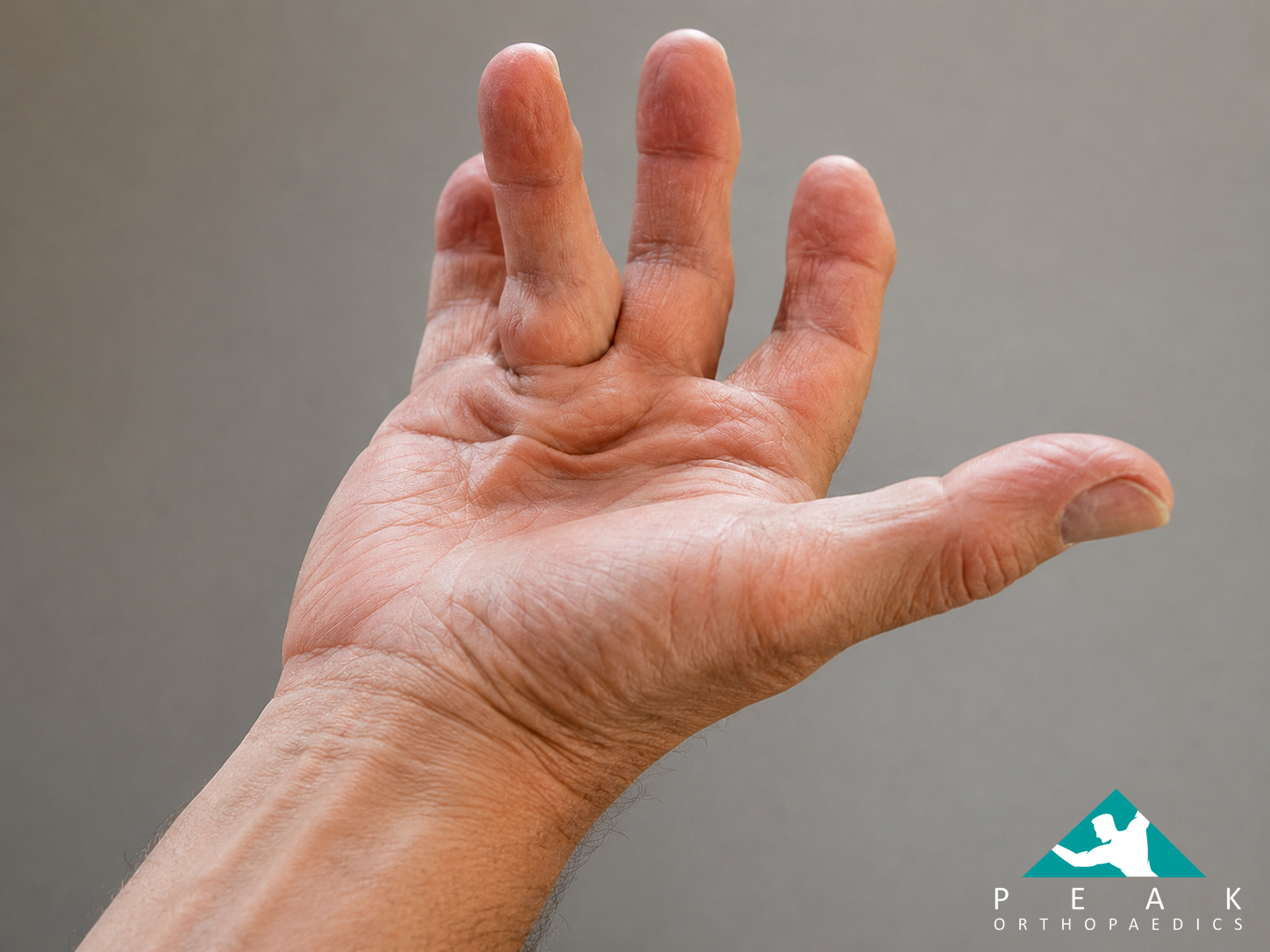Hand demonstrating Dupuytren’s contracture affecting the ring finger