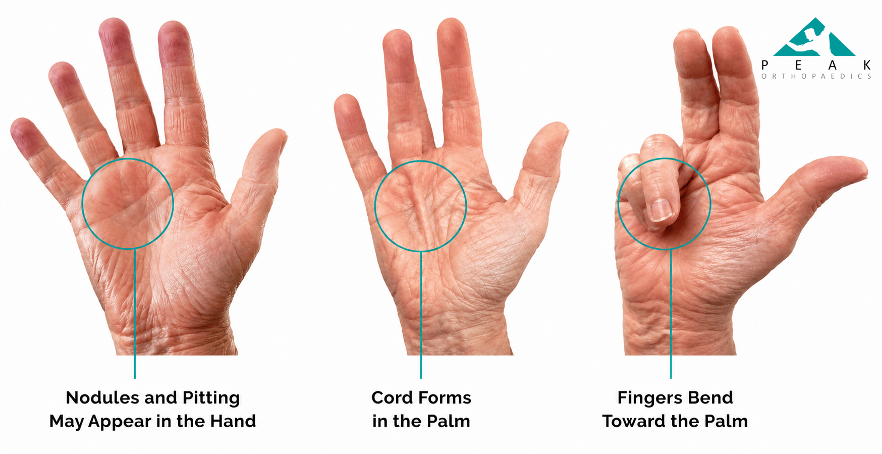 Progression of Dupuytren’s disease from palm nodules and cords to finger contracture