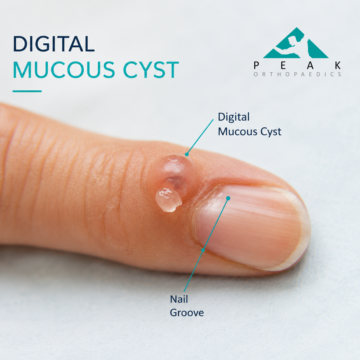 Close-up photograph of a digital mucous cyst near the fingernail causing nail groove deformity