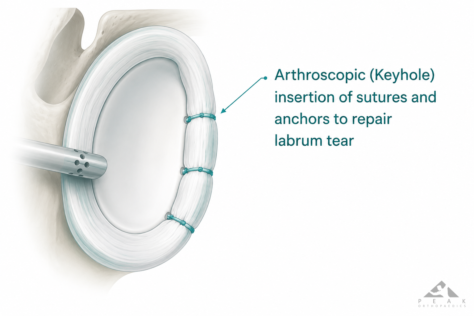 Medical illustration showing arthroscopic Bankart repair using suture anchors to repair a torn labrum and restore shoulder stability.