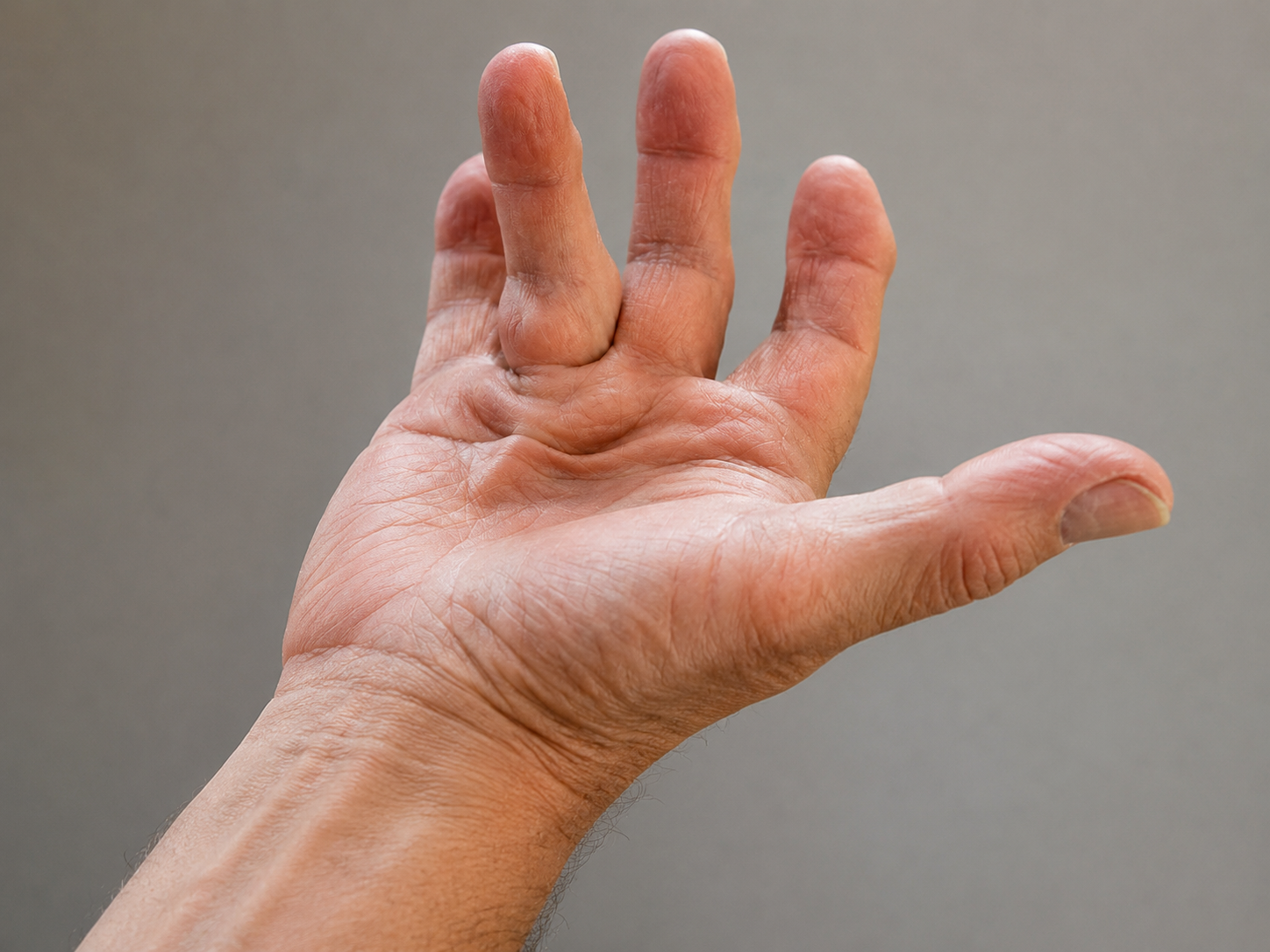 Hand demonstrating Dupuytren’s contracture affecting the ring finger