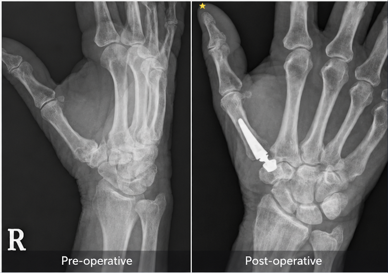 thumb arthritis base CMC joint replacement