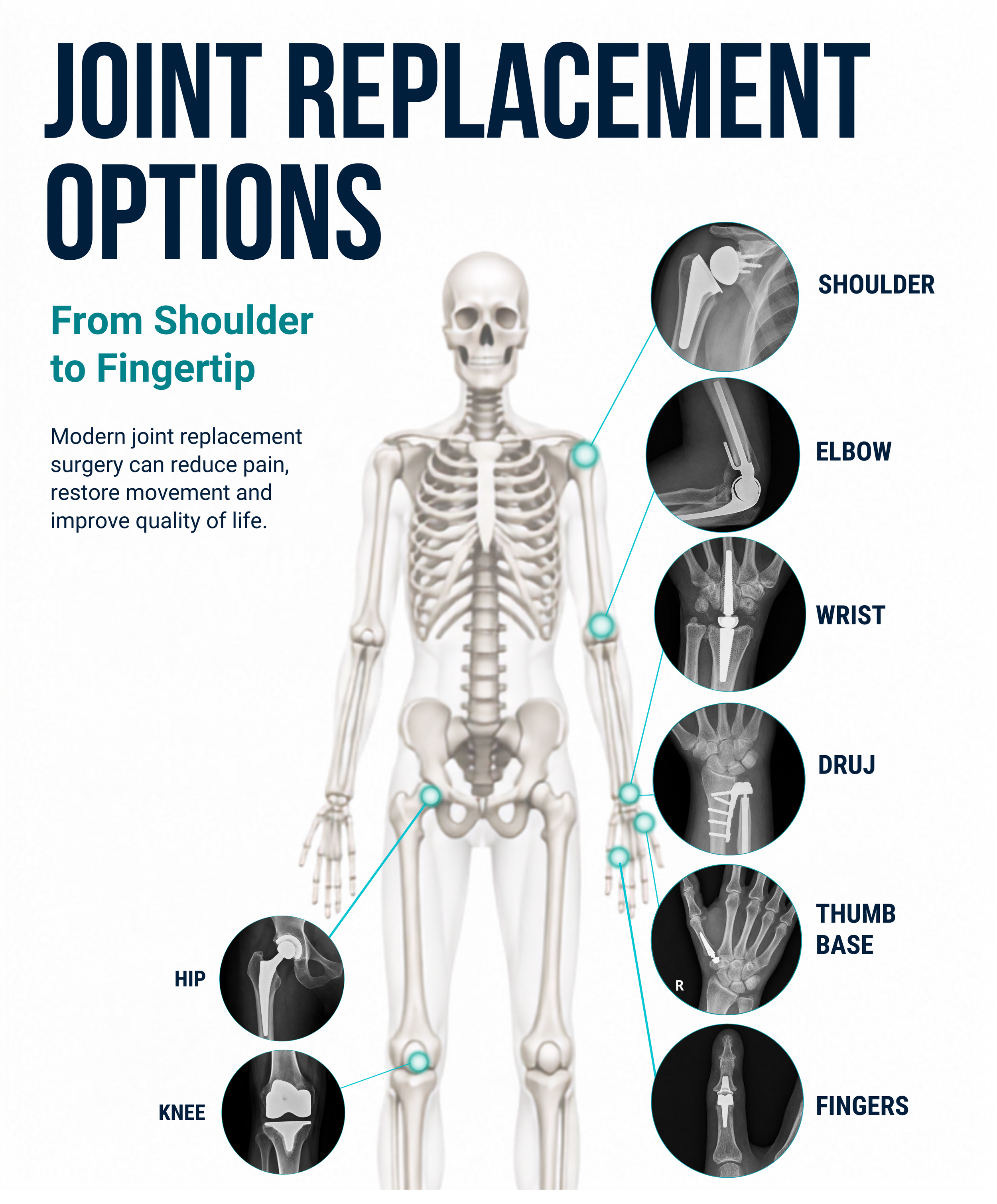 Infographic demonstrating the range of joints that can be replaced, including the shoulder, elbow, wrist, distal radioulnar joint (DRUJ), thumb base, finger joints, hip and knee.