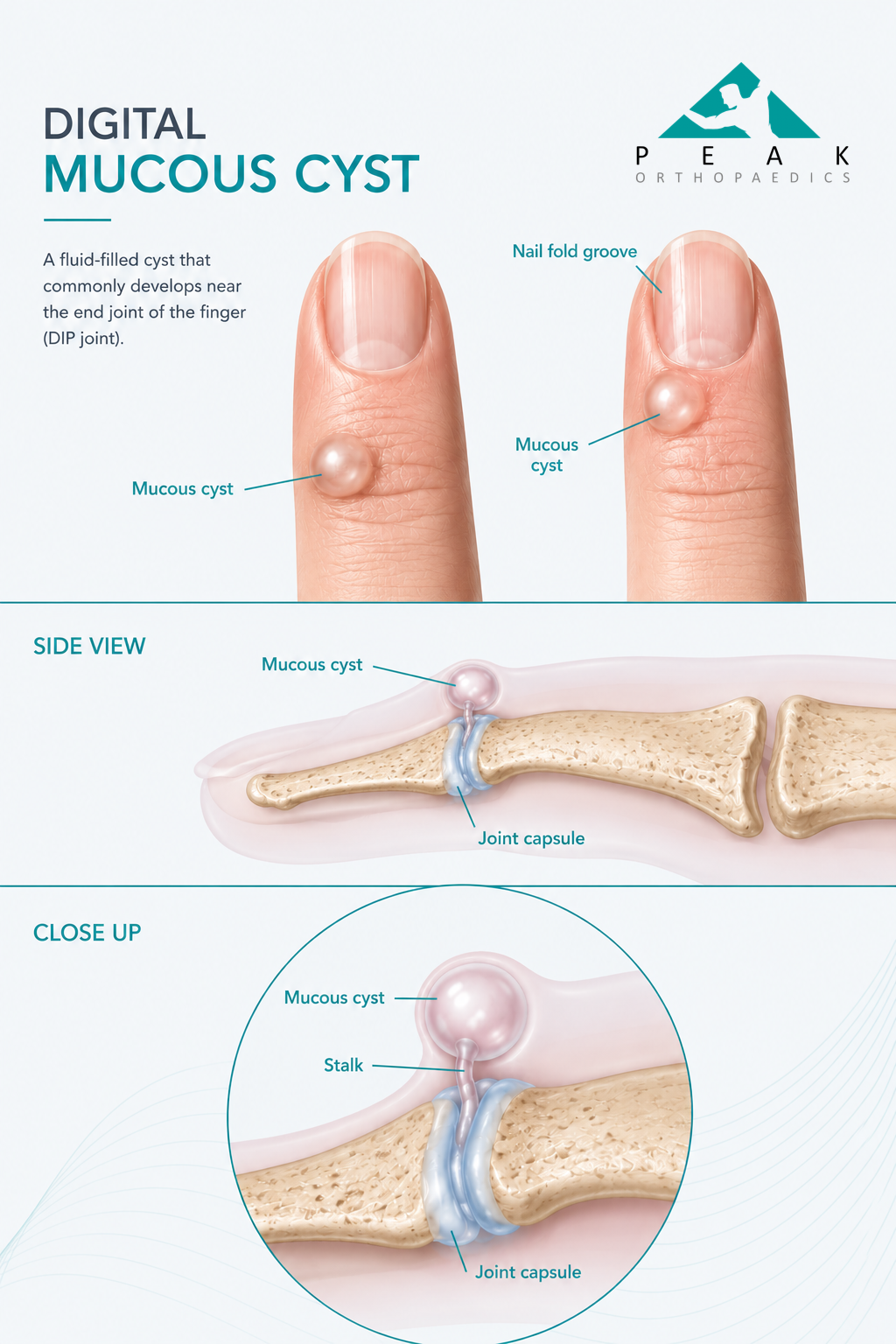 Medical illustration showing a digital mucous cyst arising from the DIP finger joint and associated nail groove deformity