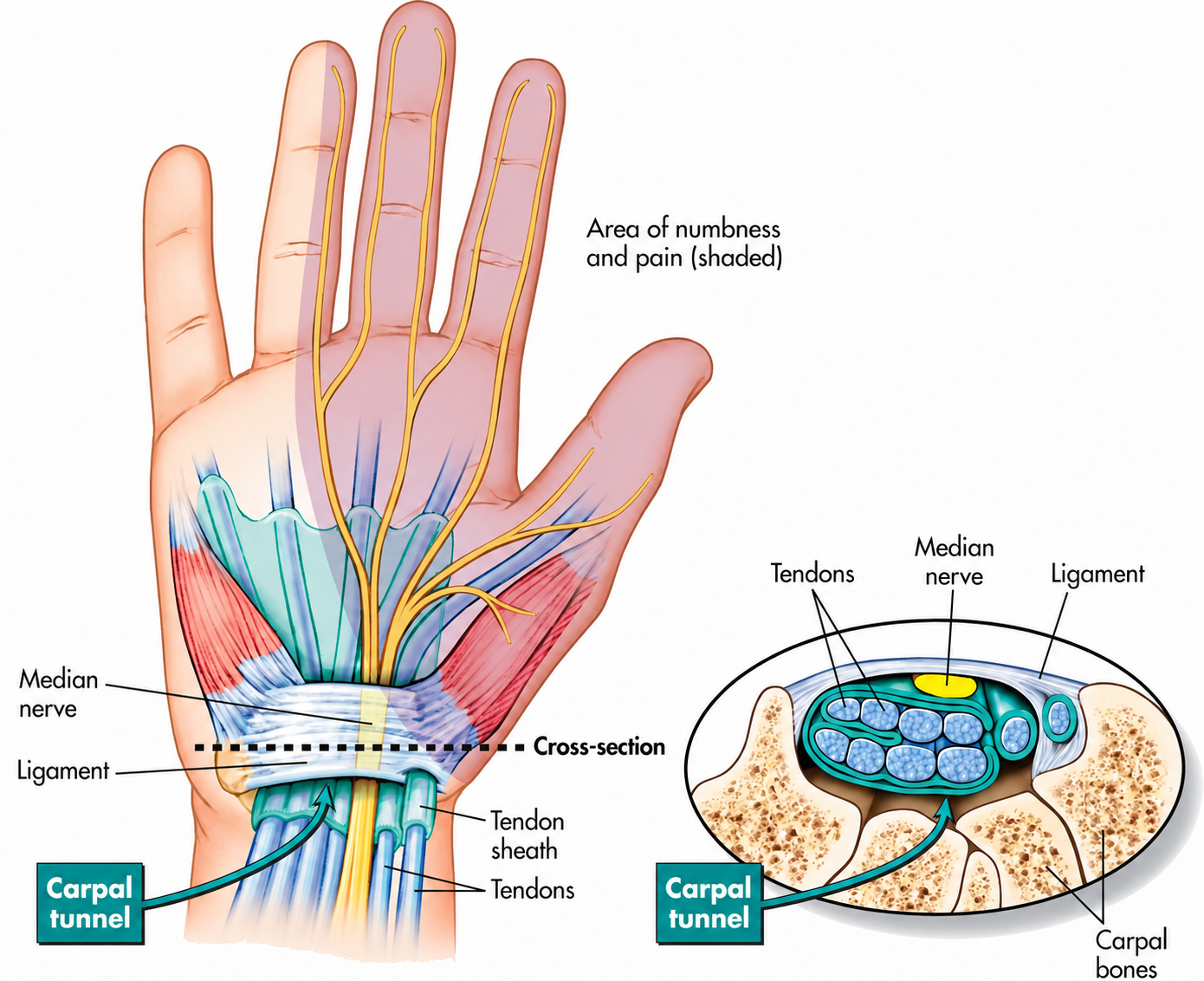 Medical illustration showing median nerve compression within the carpal tunnel and the typical area of numbness in carpal tunnel syndrome.