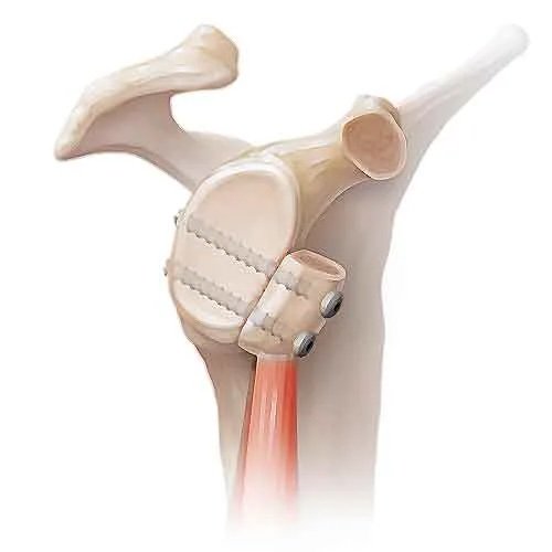 Illustration demonstrating the Latarjet procedure used to treat recurrent shoulder instability and shoulder dislocation.