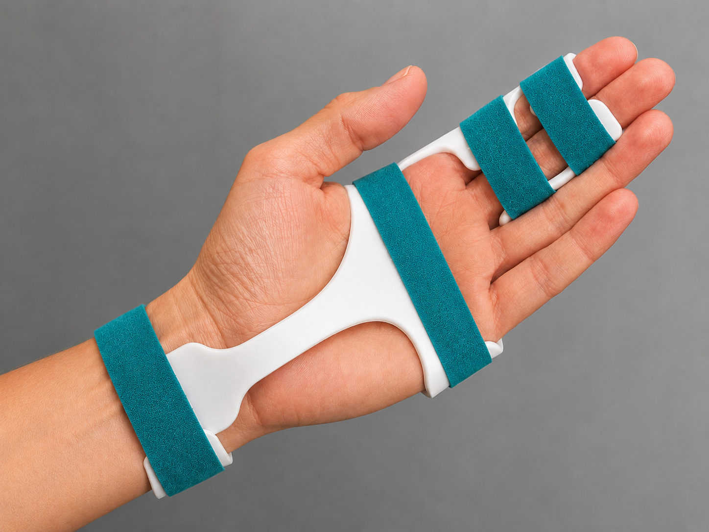 Hand extension splint used during recovery following treatment for Dupuytren’s contracture