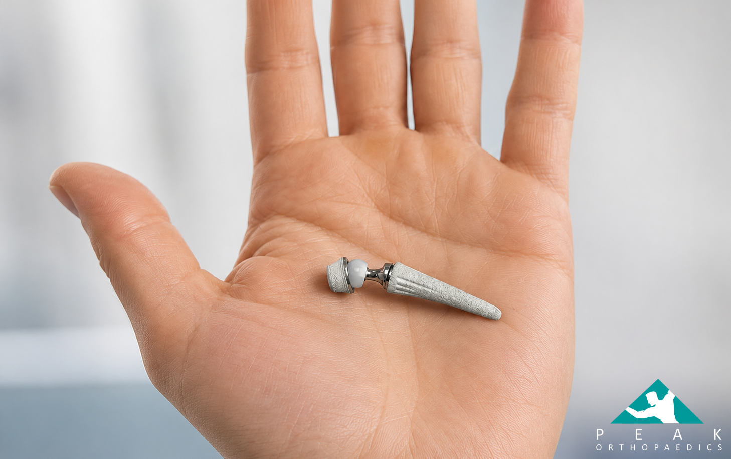 Thumb joint replacement surgery performed for painful thumb CMC arthritis