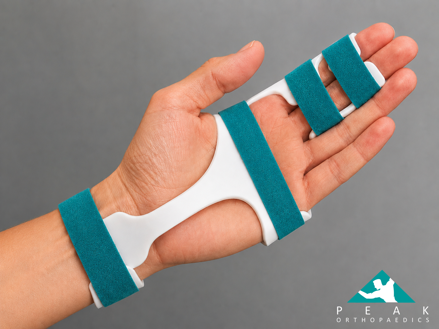 Hand extension splint used during recovery following treatment for Dupuytren’s contracture