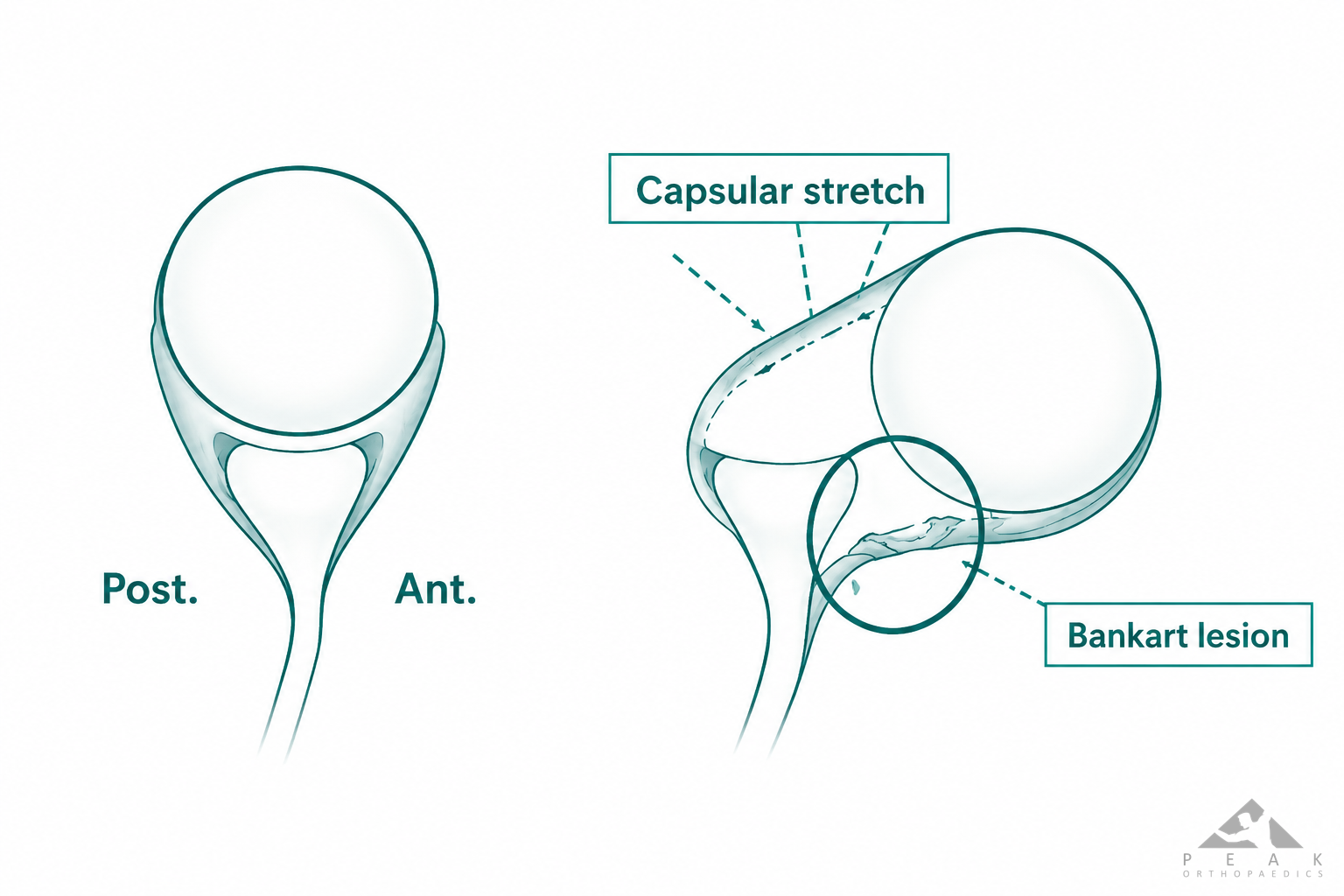 Medical illustration demonstrating shoulder instability with capsular stretching and a Bankart lesion following anterior shoulder dislocation.