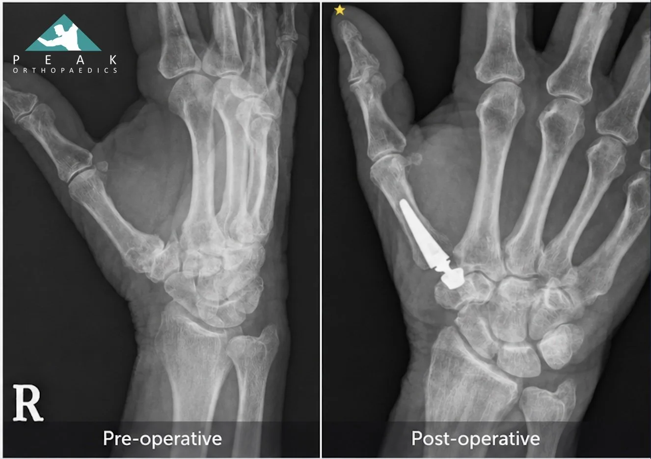 Post-operative X-ray of thumb CMC joint arthroplasty for thumb base arthritis