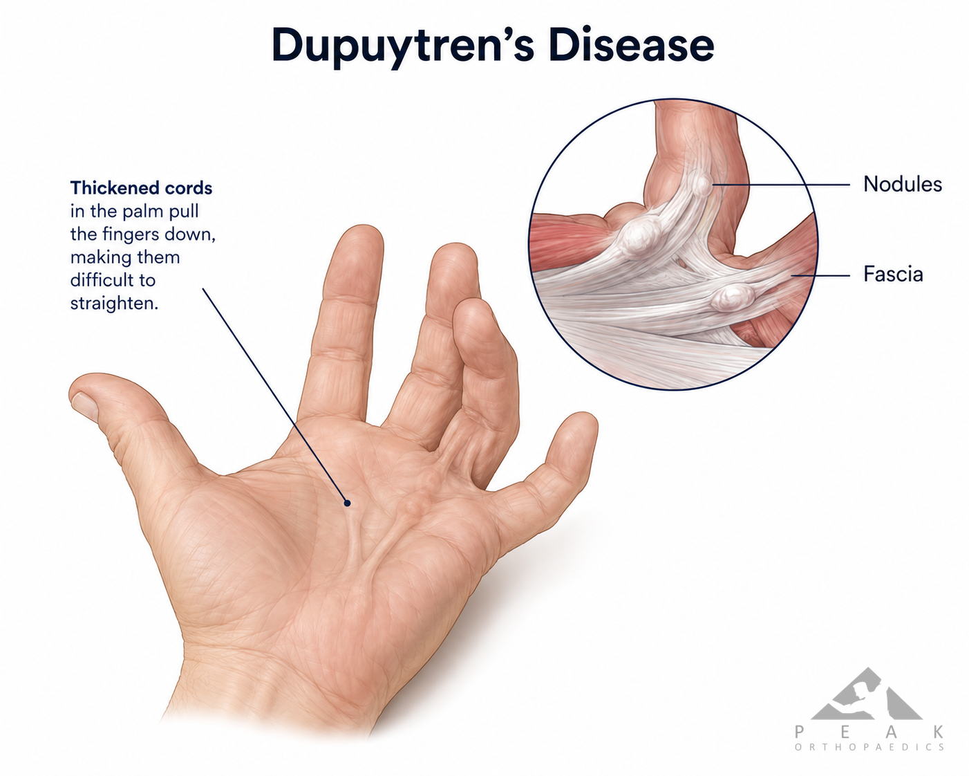 Medical illustration showing Dupuytren's disease with thickened cords and nodules in the palm causing the ring and little fingers to bend towards the palm.