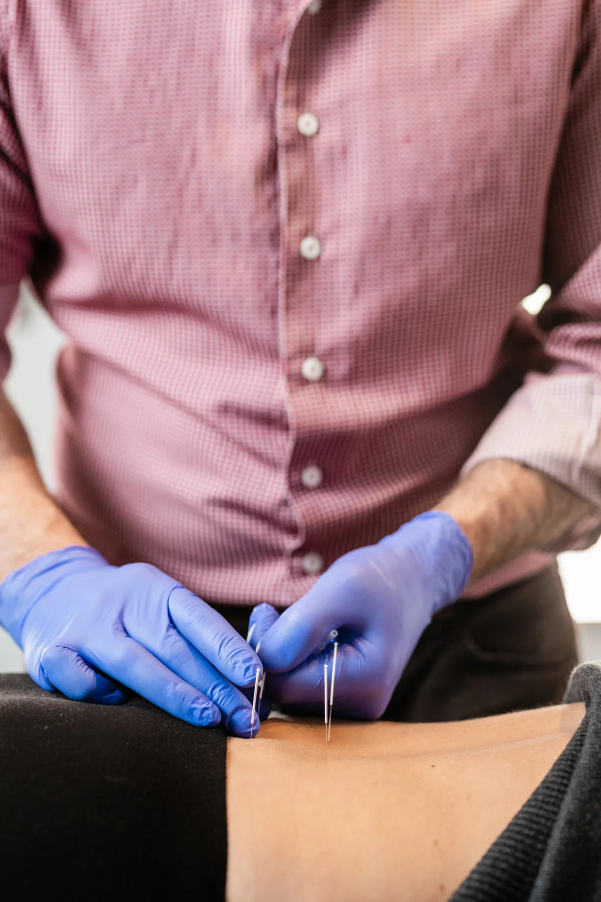 Dry Needling Technique
