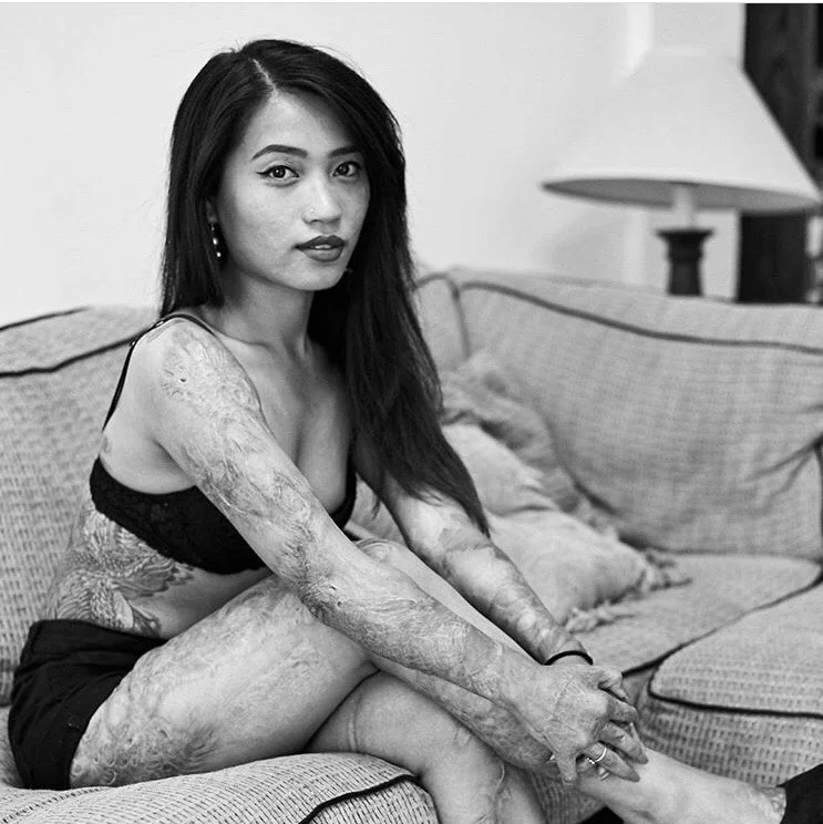 Owning My Burn Scars -- Kiki Vo on Self-Love, Healing, and The Process of Discovering Yourself After Trauma 