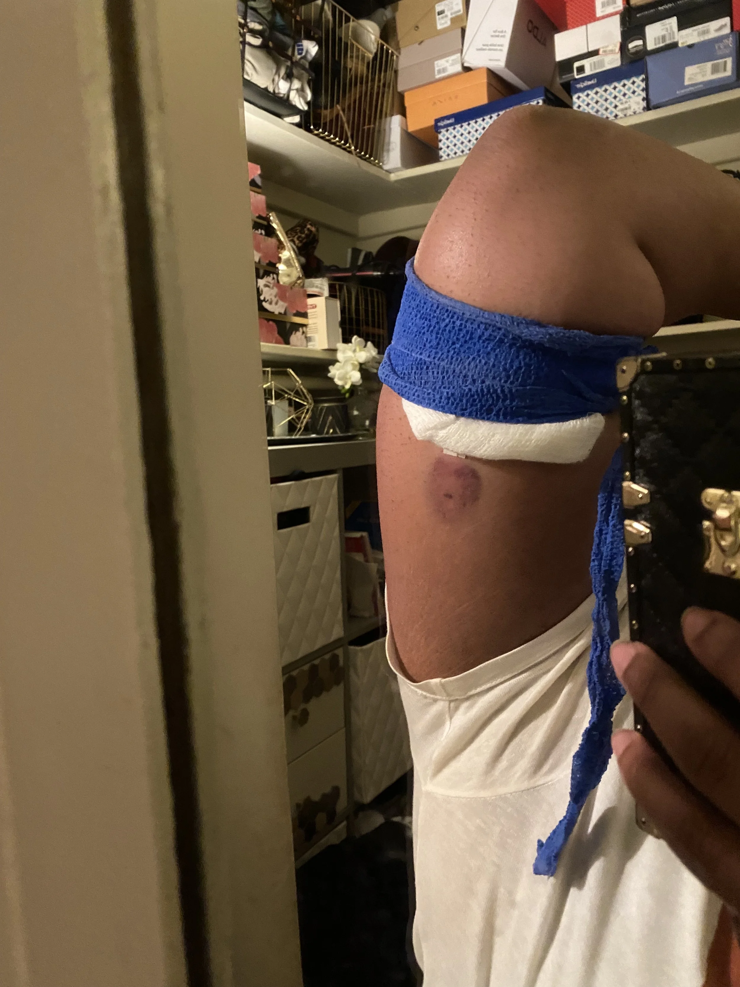 I Got The Nexplanon Birth Control Implant and This is My Experience