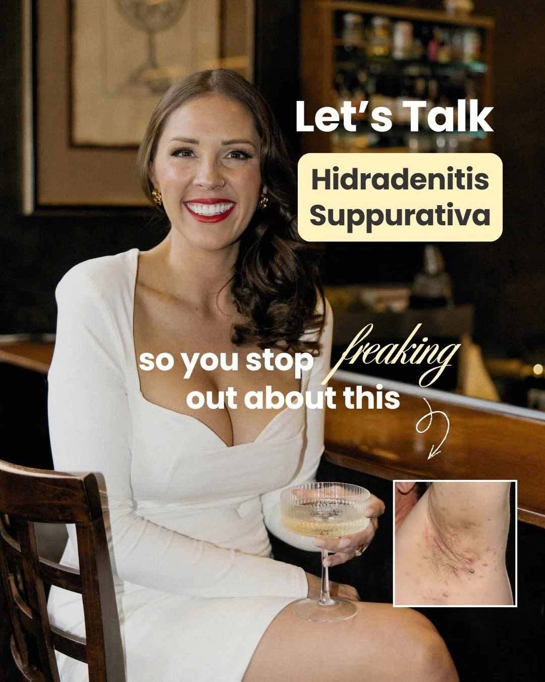 Do you have HS? 👇🏼

Comment &ldquo;HS&rdquo; so I can send you some of my top product suggestions I give to my patients to help manage their HS better. 

Hidradenitis suppurativa is potentially linked to your hormones and your PMOS. We know BOTH co