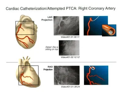 Cardiac Catheterization