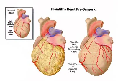 Abnormal Heart Anatomy