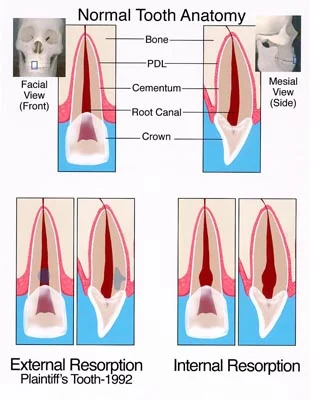 Resorption