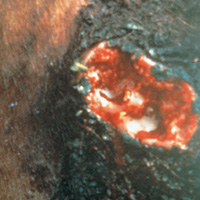 Stomach_Worm_Pic_34.jpg