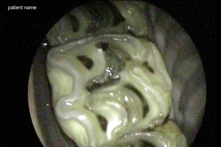 Infundibular caries present