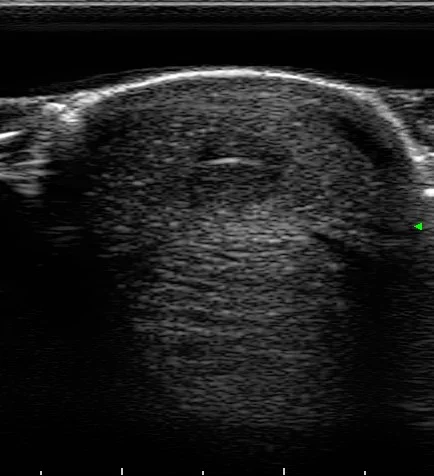 Can you spot the hole in this tendon?