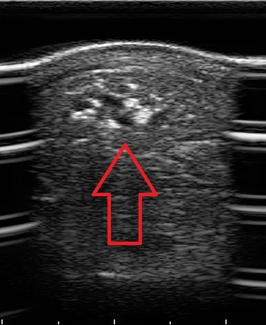 This is the same tendon lesion, with Platelet Rich Plasma (PRP) injected directly into the lesion.