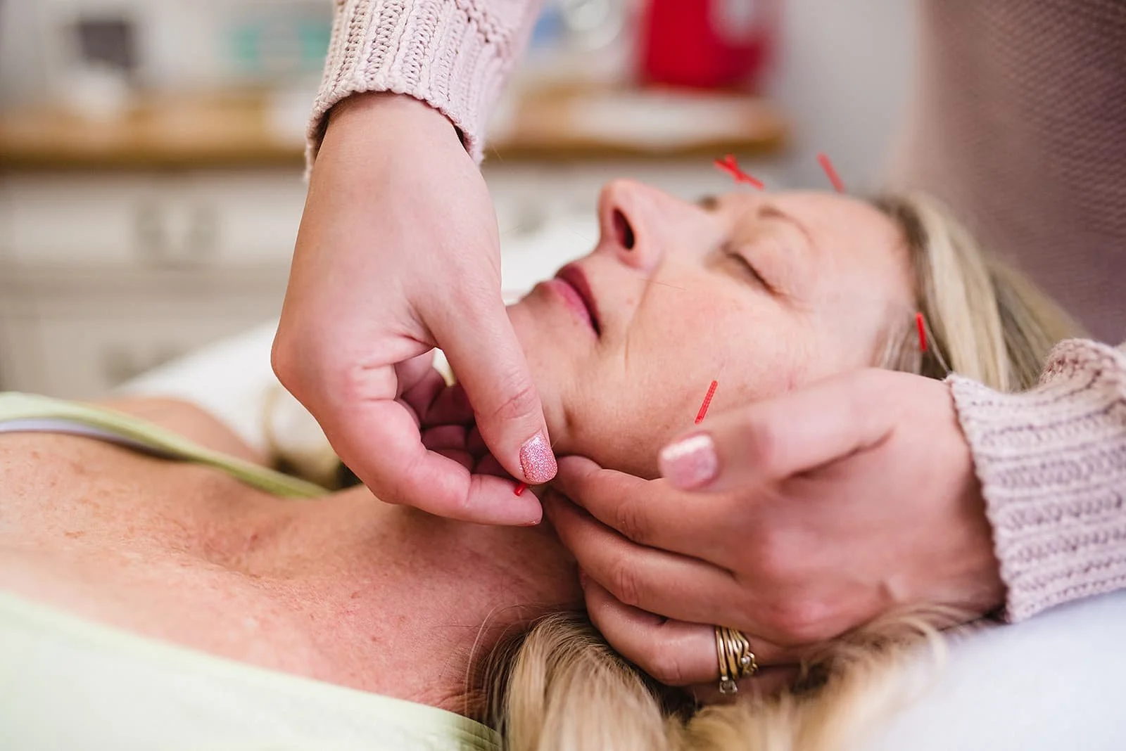 Does Facial Acupuncture Really Work? A Closer Look