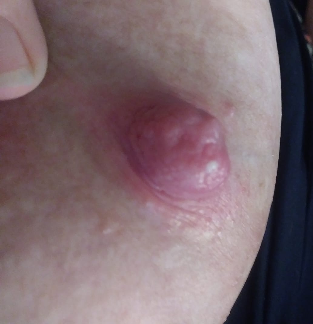Lump nipple white on Bumps on