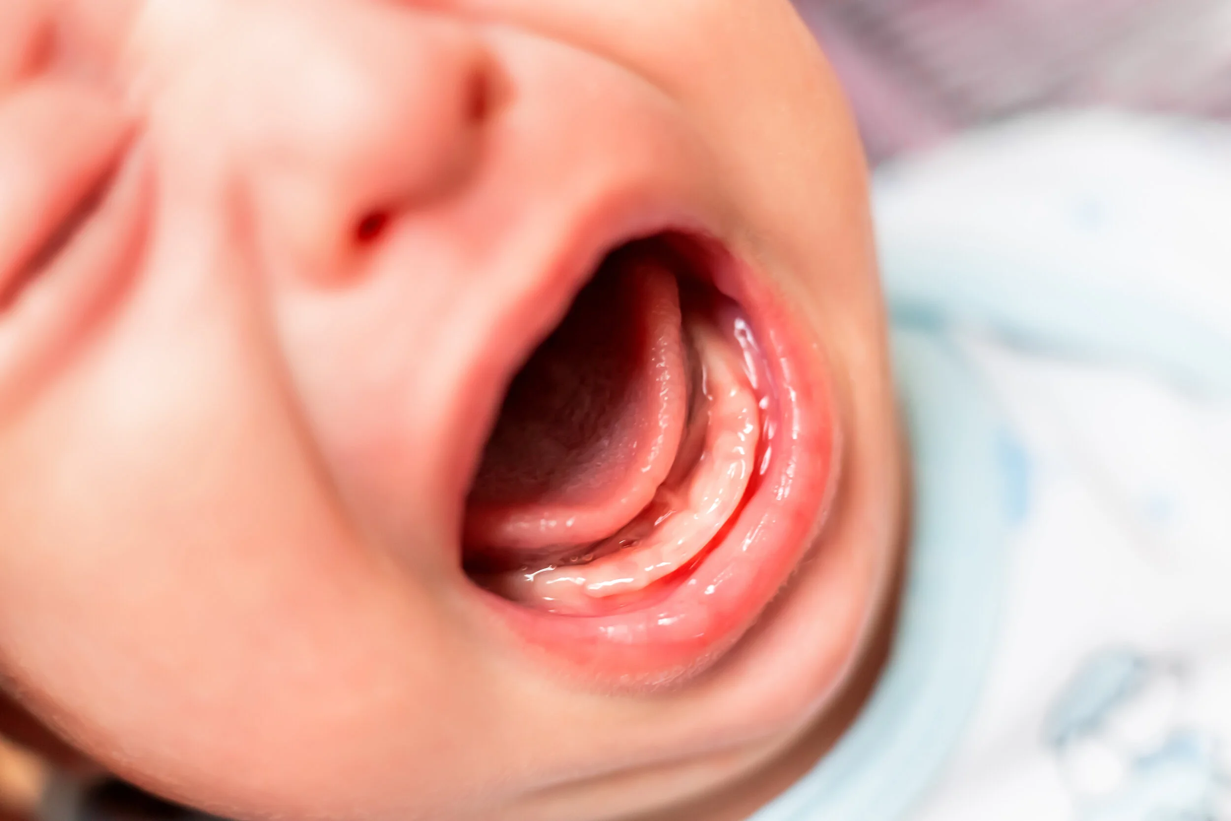 What Are Oral Ties In Babies