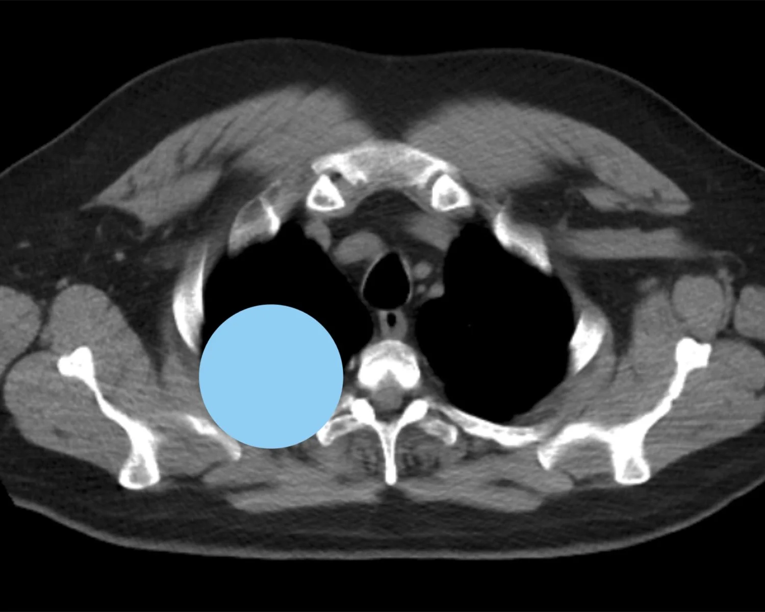 image 8 lung.jpg