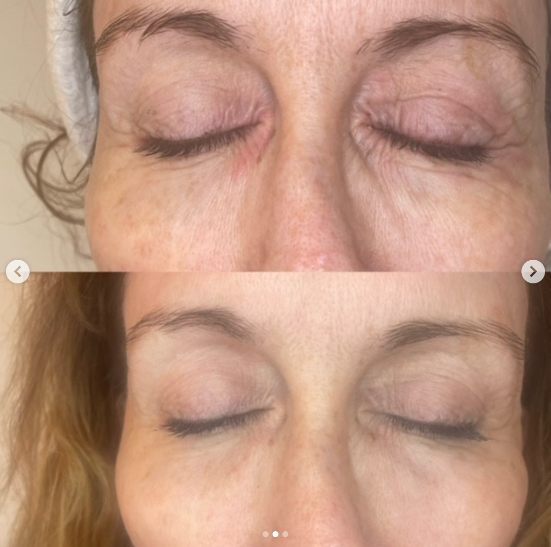 We’ve tried a lot of skin tightening treatments, and wanted to talk about all the hype around Tixel. 