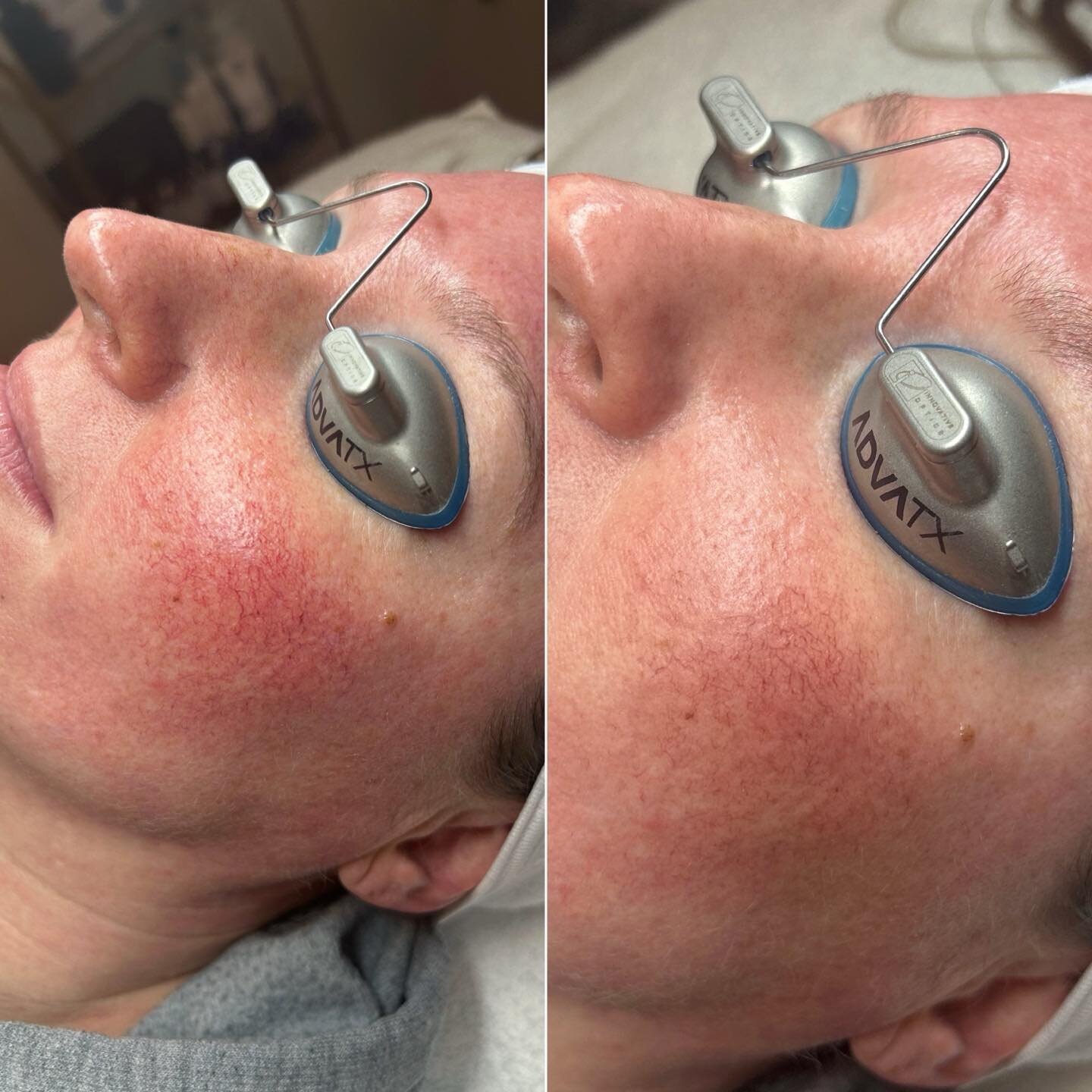 What happens if rosacea is left untreated?

Without treatment, rosacea can become more noticeable. For example, the long-lasting flushing can become permanent redness on your face. Spider veins may appear on your cheeks. Some people develop acne-like