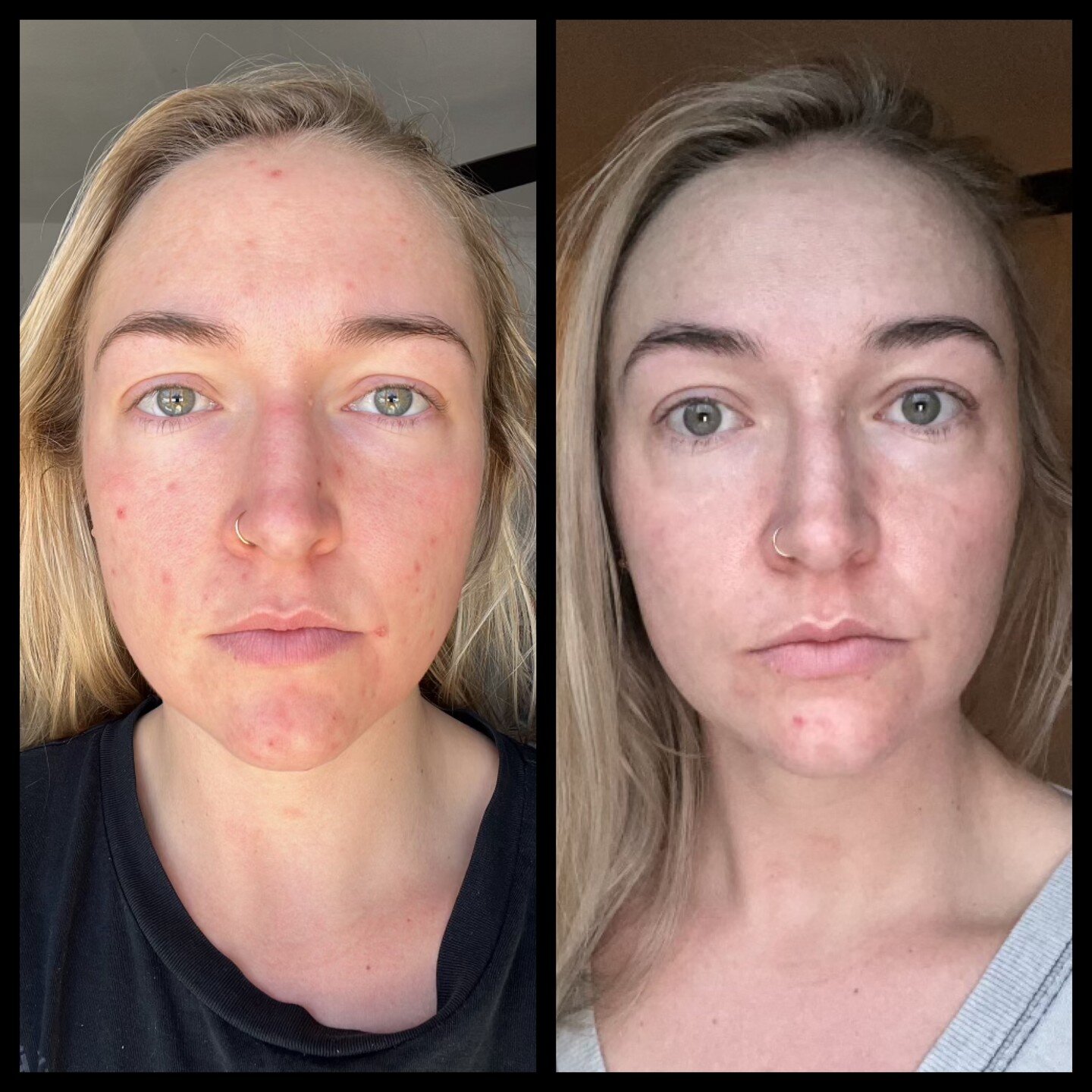 Nikki's client came in struggling with active acne and hyperpigmentation. This photo was just 10 days after one combo of AdvaTX + mandelic peel. Her breakouts are almost nonexistent and a lot of pigment was lifted!

AdvaTX will immediately shut down 