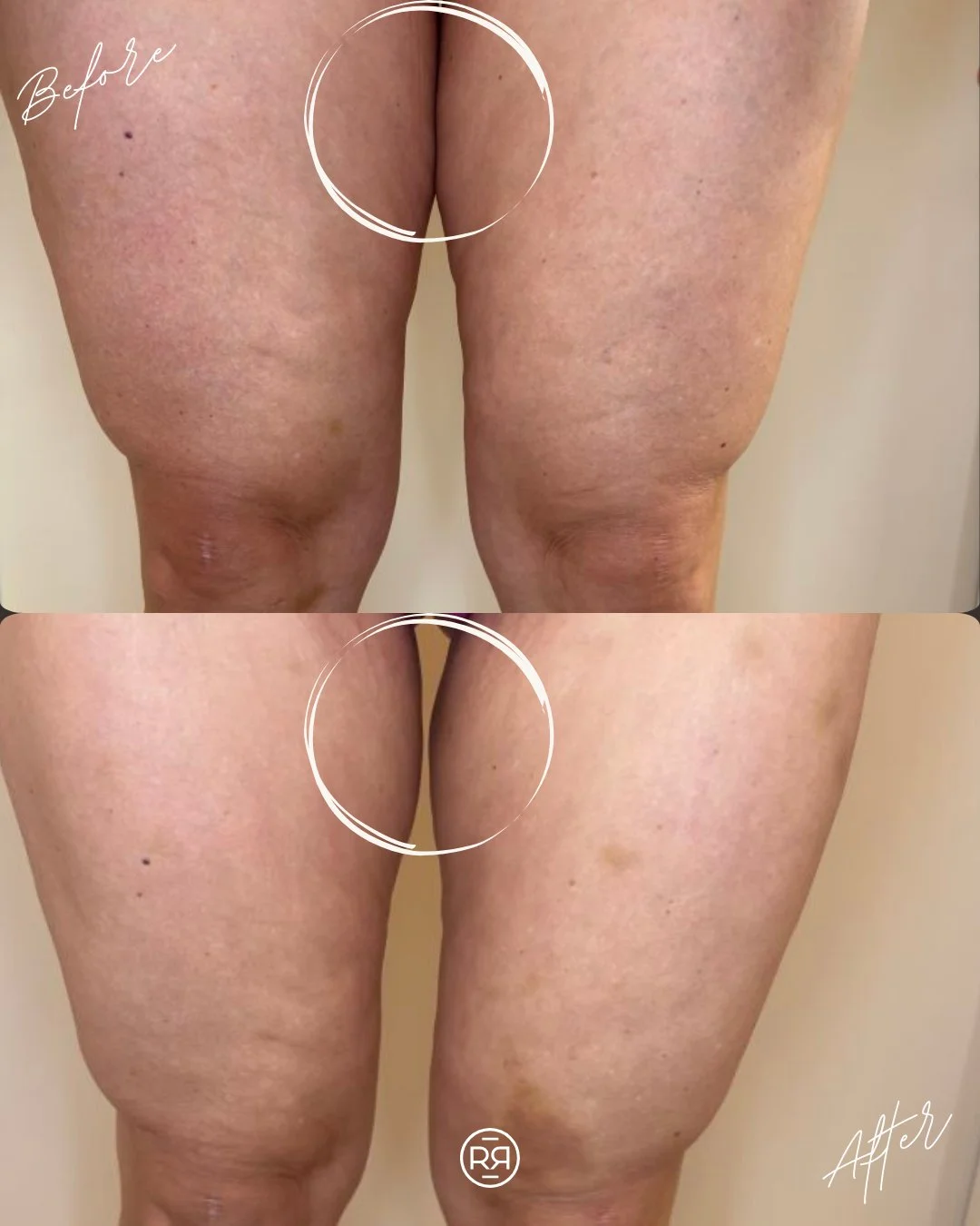 Inner thigh transformation! 🔥
You can clearly see a reduction in volume in this stubborn area &mdash; giving the legs a more streamlined, contoured look. These results are so satisfying! 

#medicalspa #medicalaesthetics #aesthetician #esthetician #s